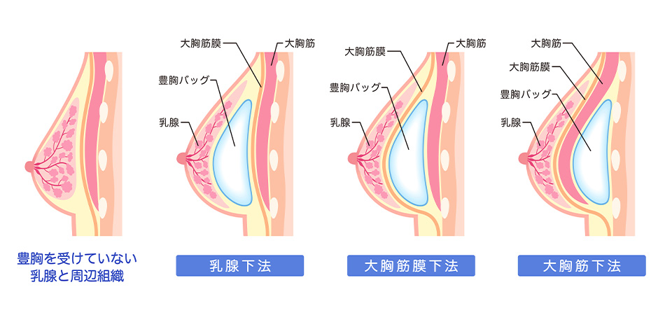 豊胸（シリコンバッグ）