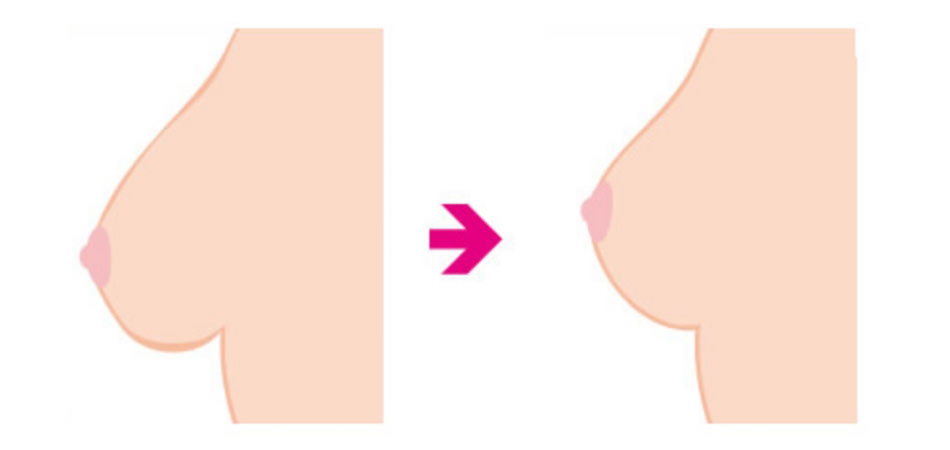 乳房吊り上げ