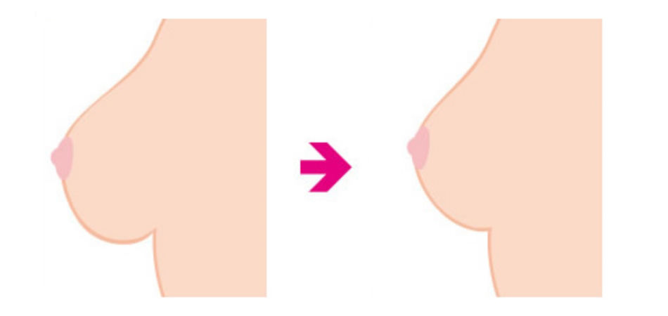 乳房縮小