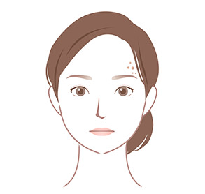 脂漏性角化症（老人性イボ）
