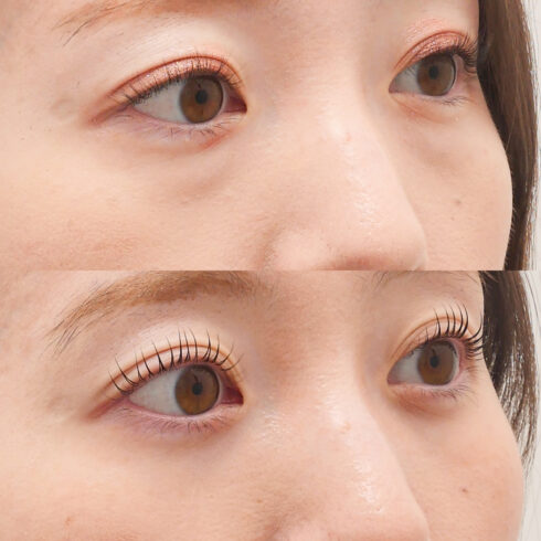 下眼瞼脱脂術（経結膜法）の症例写真