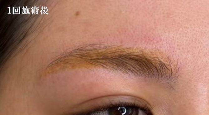 1回施術後