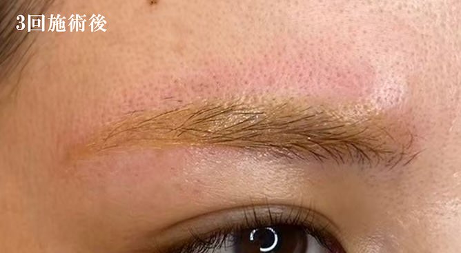 3回施術後