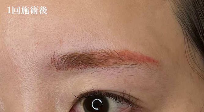 1回施術後