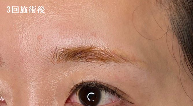 3回施術後
