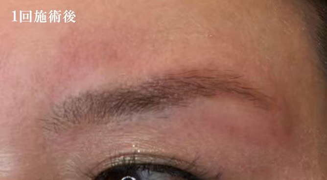 1回施術後