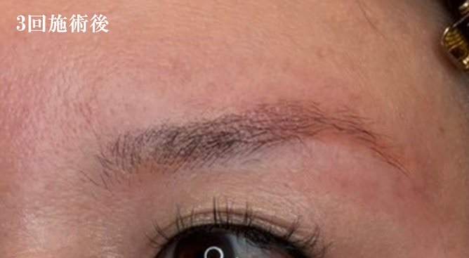 3回施術後