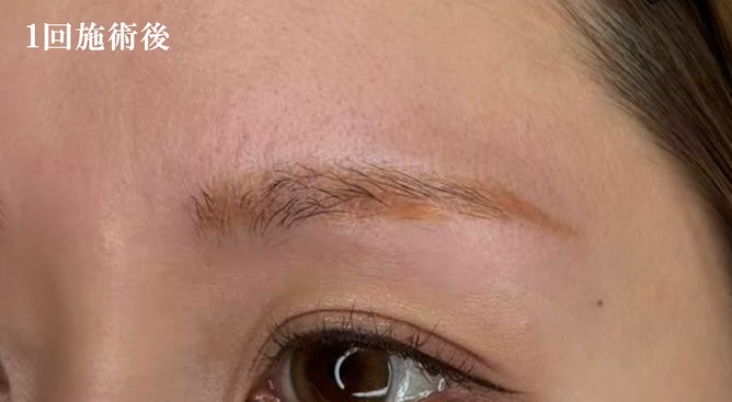1回施術後