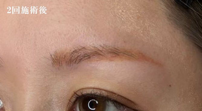 2回施術後