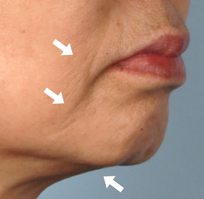 1回治療3か月後