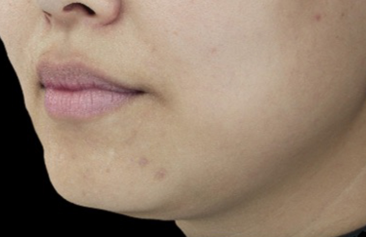 1回治療3か月後