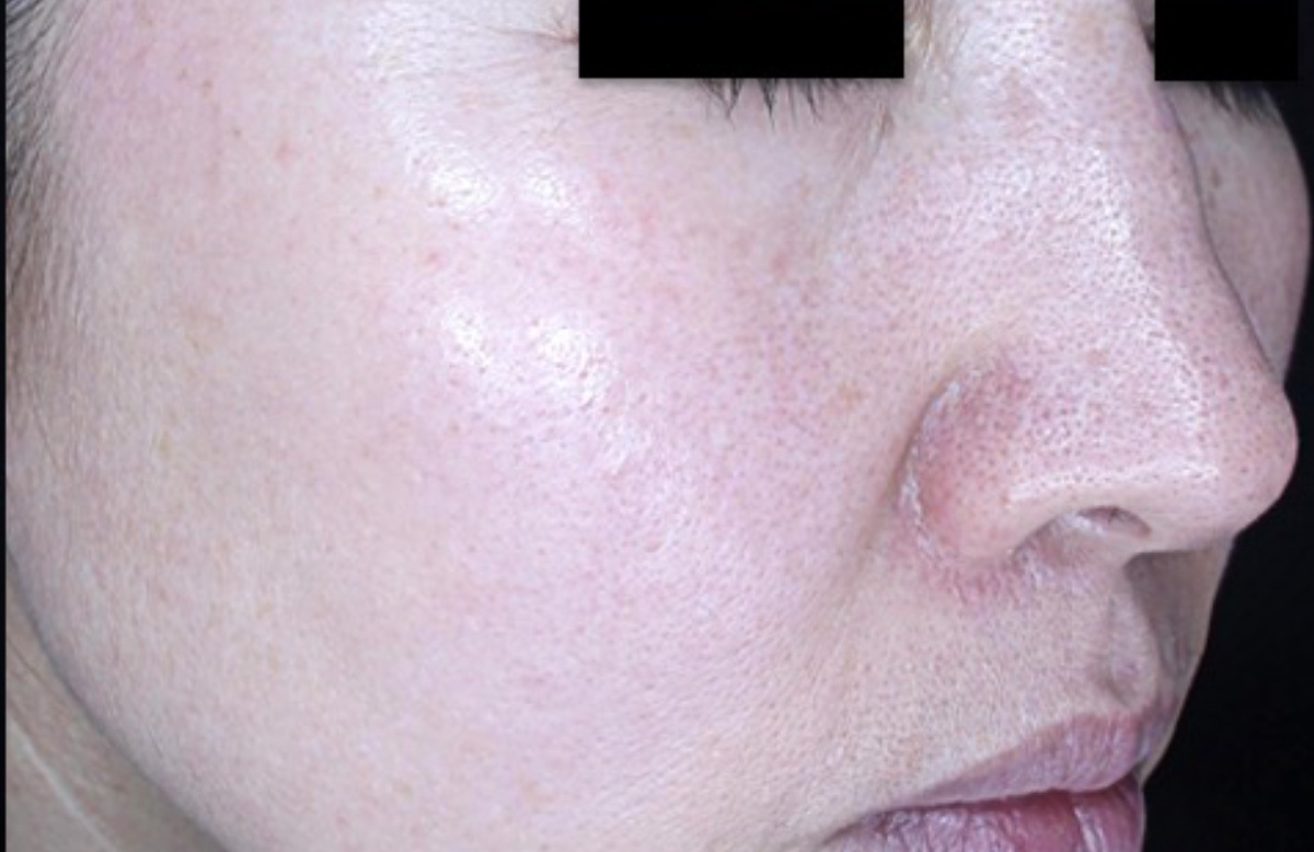 1回治療6か月後